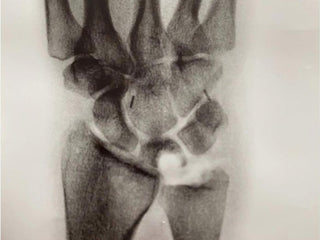 An x ray of professional rock climber and photographer Savannah Cummins broken bone.