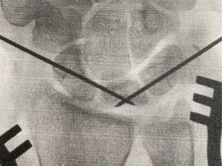 An x ray showing the pins in professional rock climber and photographer Savannah Cummins' bone.